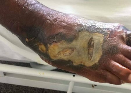 Familía desesperada pede por socorro, para tratamento médico a homem com doença grave no pé.