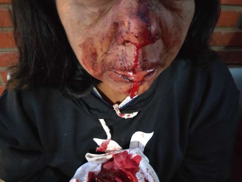 Mulher é agredida com garrafadas no rosto por adolescente