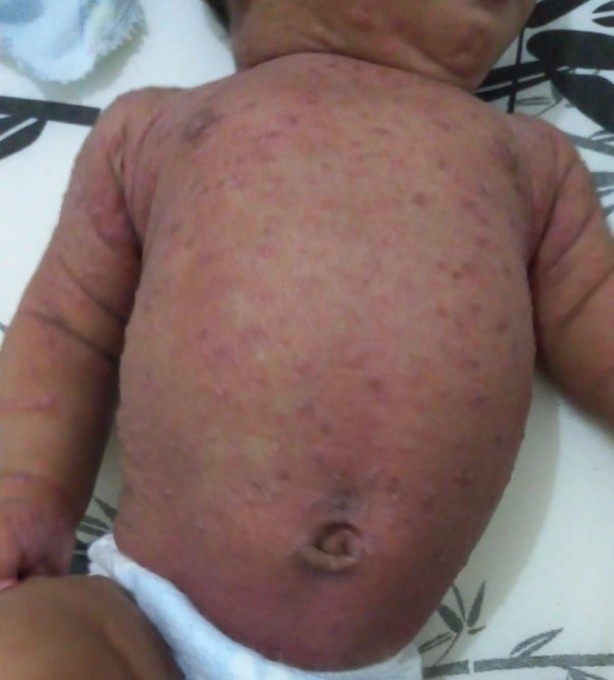 Sarna humana volta a preocupar e bebê de 2 meses é internado
