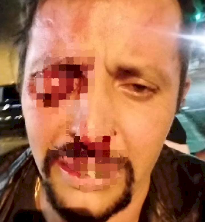 Homem cai sobre haste de retrovisor e perde olho durante briga de rua.