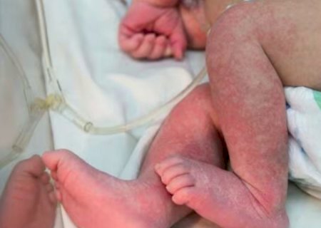 Em 24h, Dourados tem 60 novos casos confirmados de chikungunya